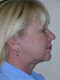Facelift Cosmetic Surgery After