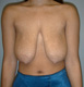 breast-lift-augmentation-surgeon-before