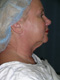Facelift Cosmetic Surgery Before