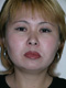 facelift-surgery-before
