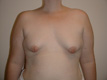 reconstructive-breast-surgery-before